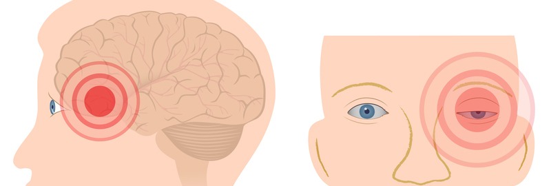 cluster-headache pic