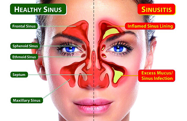 sinus headache pic